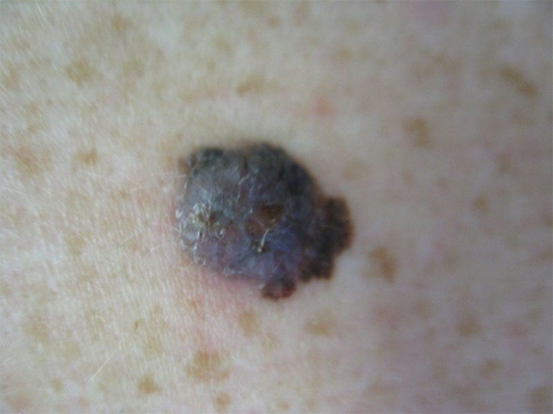 Skin Cancer – Brunswick Dermatology Centre